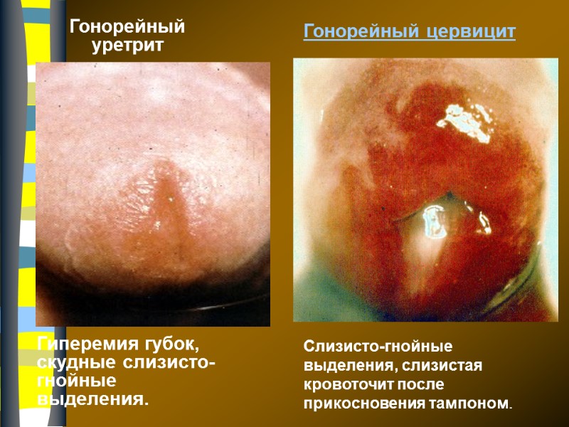 Гонорейный уретрит Гонорейный цервицит  Гиперемия губок, скудные слизисто-гнойные выделения.  Слизисто-гнойные выделения, слизистая